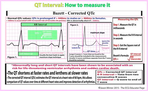 bazzet|QT interval